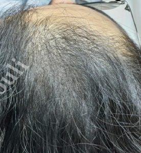 تاثیر مزوتراپی قبل