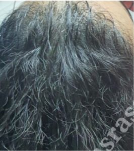 تاثیر مزوتراپی بعد