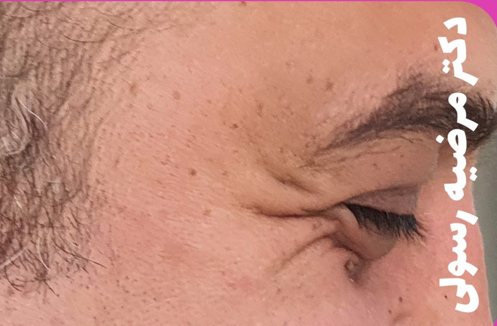 بوتاکس پنجه کلاغی در کرج