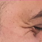 بوتاکس پنجه کلاغی در کرج