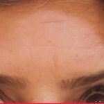 بوتاکس پیشانی در کرج