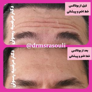 بوتاکس پیشانی در کرج