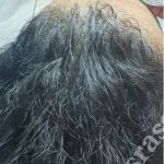مزوتراپی موی سر2