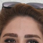 قبل از تزریق بوتاکس لیفت ابرو  کرج