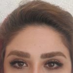 پس از تزریق بوتاکس لیفت ابرو کرج