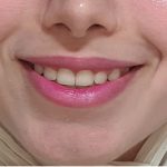 لبخند لثه ای بوتاکس