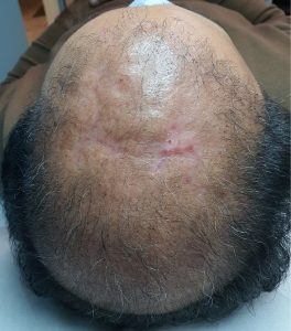 مزوتراپی موی سر3