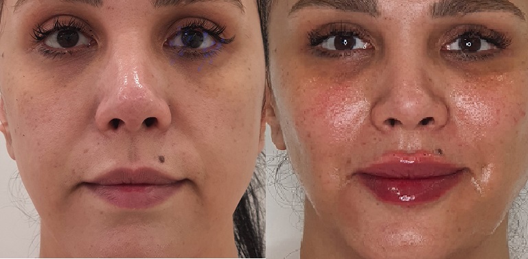تزریق ژل گونه در کرج