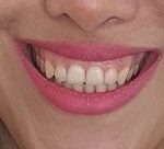 بوتاکس لثه