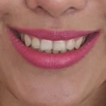 بوتاکس لثه بعد از تزریق