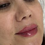 تزریق ژل لب در کلینیک پوست و م و زیبایی فلورین جهانشهر کرج با بهترین ژل و مناسبترین قیمت