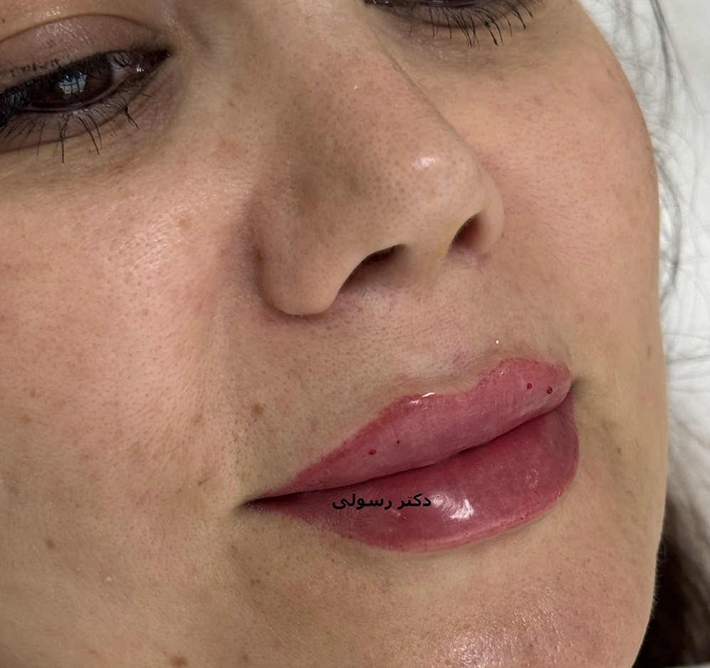 تزریق ژل لب در کلینیک پوست و م و زیبایی فلورین جهانشهر کرج با بهترین ژل و مناسبترین قیمت