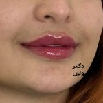 تزریق ژل لب در کلینیک پوست و م و زیبایی فلورین جهانشهر کرج با بهترین ژل و مناسبترین قیمت