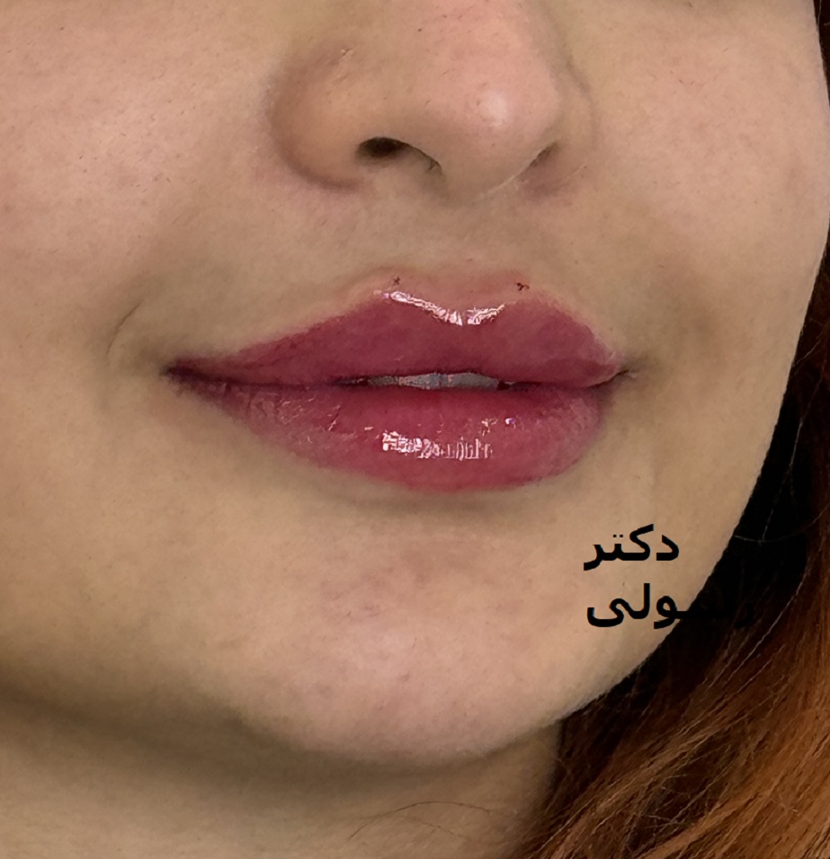تزریق ژل لب در کلینیک پوست و م و زیبایی فلورین جهانشهر کرج با بهترین ژل و مناسبترین قیمت