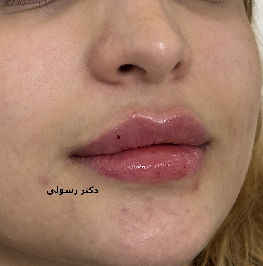 تزریق ژل لب در کلینیک پوست و م و زیبایی فلورین جهانشهر کرج با بهترین ژل و مناسبترین قیمت