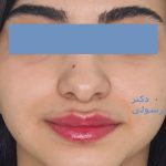 تزریق ژل لب در کلینیک پوست و م و زیبایی فلورین جهانشهر کرج با بهترین ژل و مناسبترین قیمت
