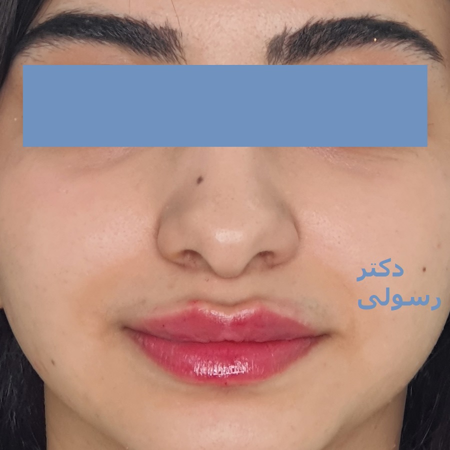 تزریق ژل لب در کلینیک پوست و م و زیبایی فلورین جهانشهر کرج با بهترین ژل و مناسبترین قیمت