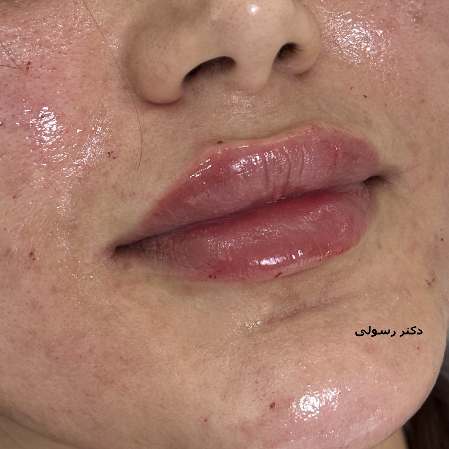 تزریق ژل لب در کلینیک پوست و م و زیبایی فلورین جهانشهر کرج با بهترین ژل و مناسبترین قیمت